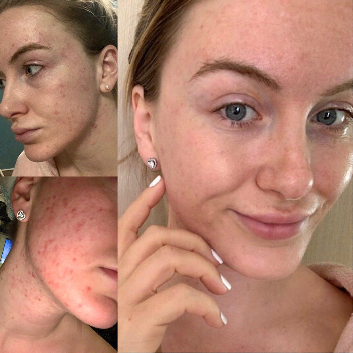 Argan Acne Rehab Serum 30ml | Plant-Based Formula for Acne-Prone Skin – view 5