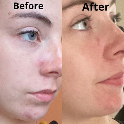 Argan Acne Rehab Serum 30ml | Plant-Based Formula for Acne-Prone Skin – view 9
