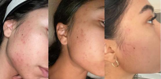 Argan Acne Rehab Serum 30ml | Plant-Based Formula for Acne-Prone Skin – view 4